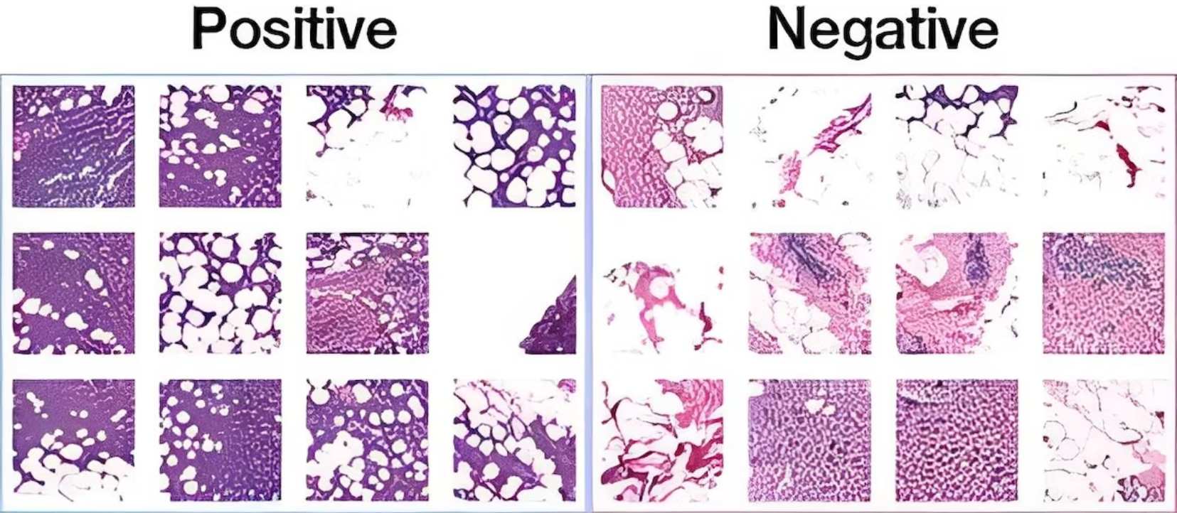 breast_cancer.png